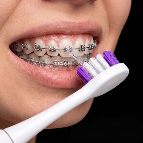 Best Electric Toothbrush for Braces in the UK (2026 Guide)